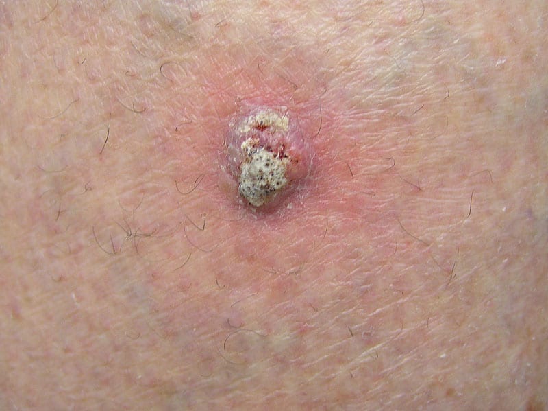 Squamous cell carcinoma